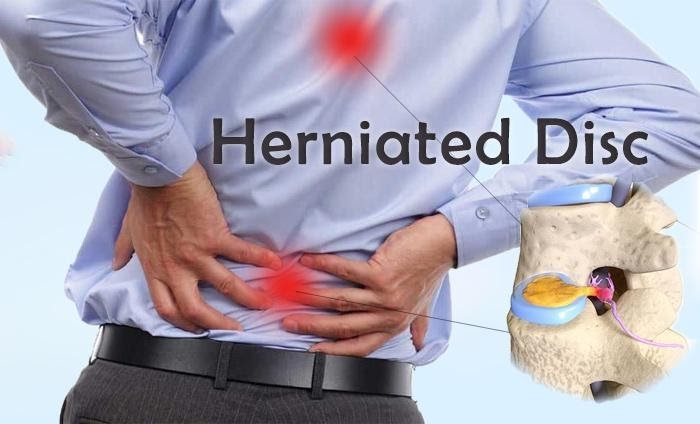 Herniated Disc