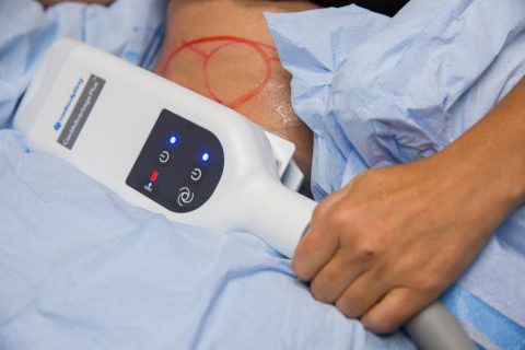 best at home coolsculpting machine