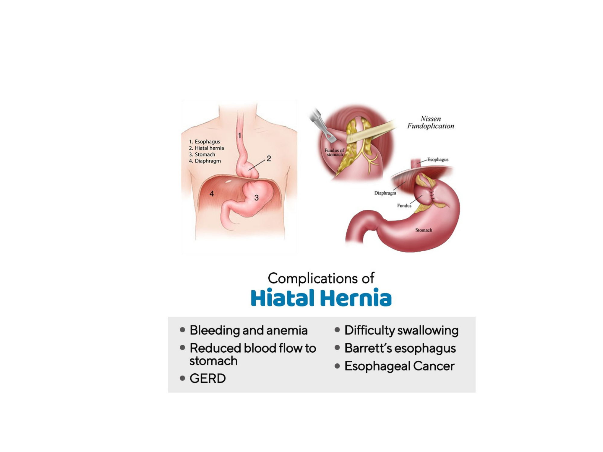 hernia treatment in Kolkata