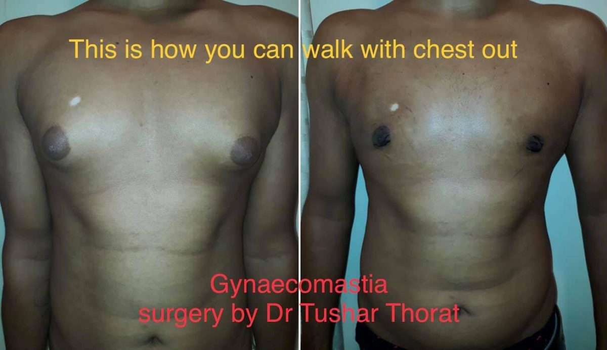 Best Treatment Plan For The Enlargement Of Breast Glandular Tissues In Males With The Help Of Gynecomastia Treatment In Mumbai