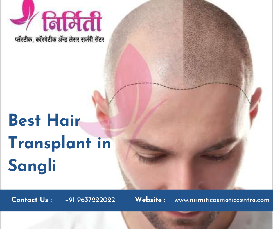 Hair Transplant in Sangli
