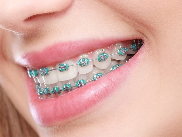 orthodontic treatment