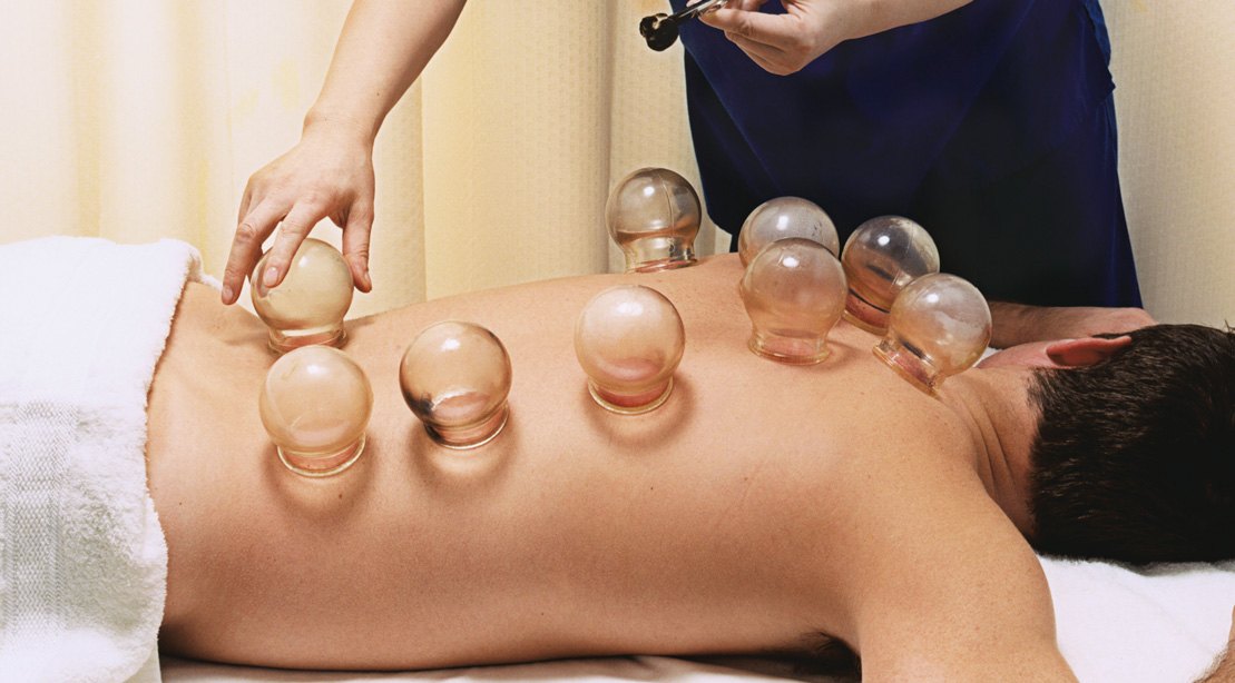 cupping therapy