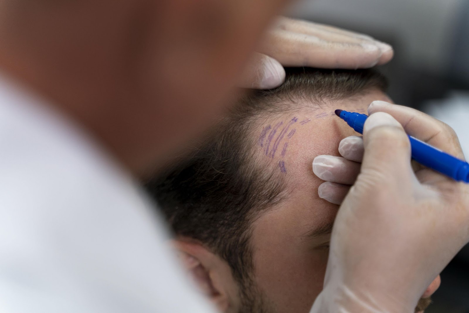 hair transplant