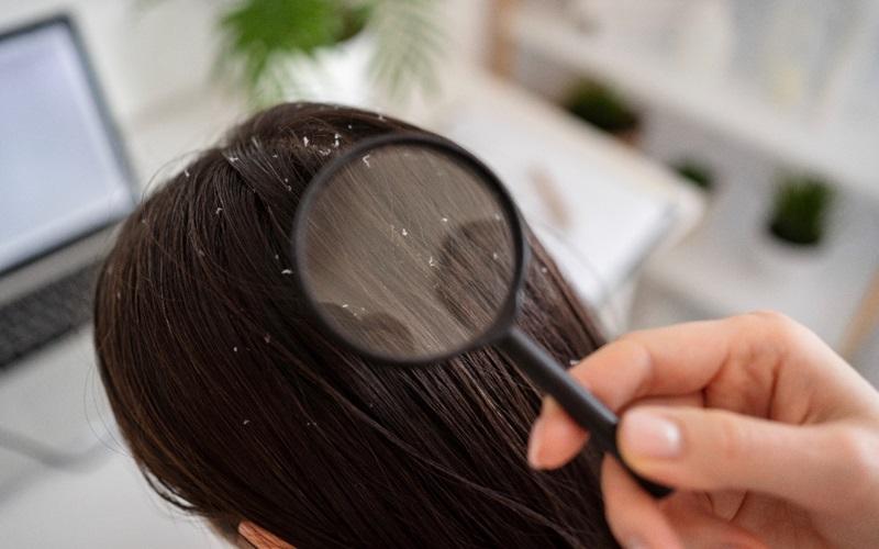 dandruff