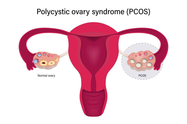 pcos belly