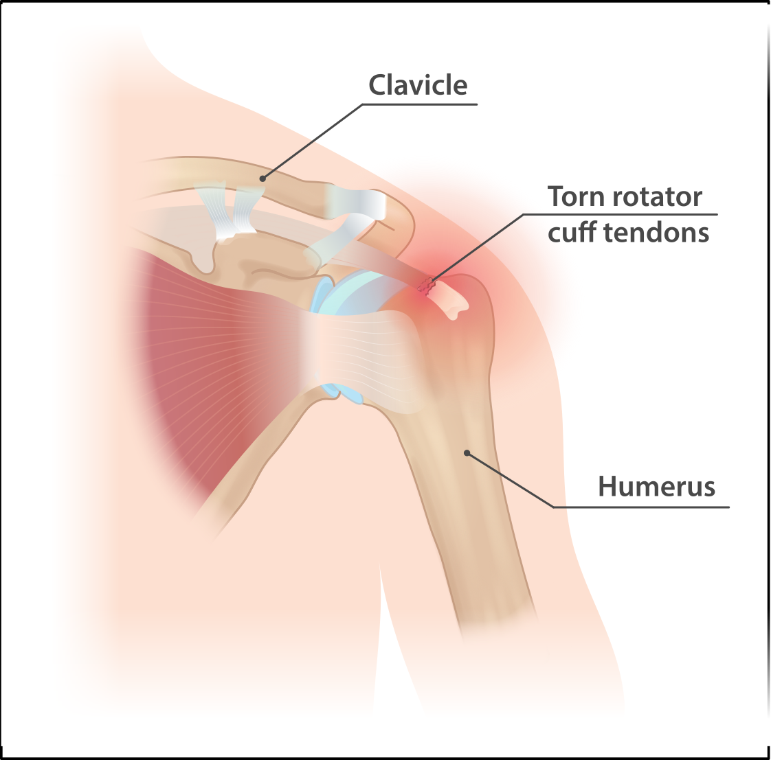 rotator cuff tendinopathy