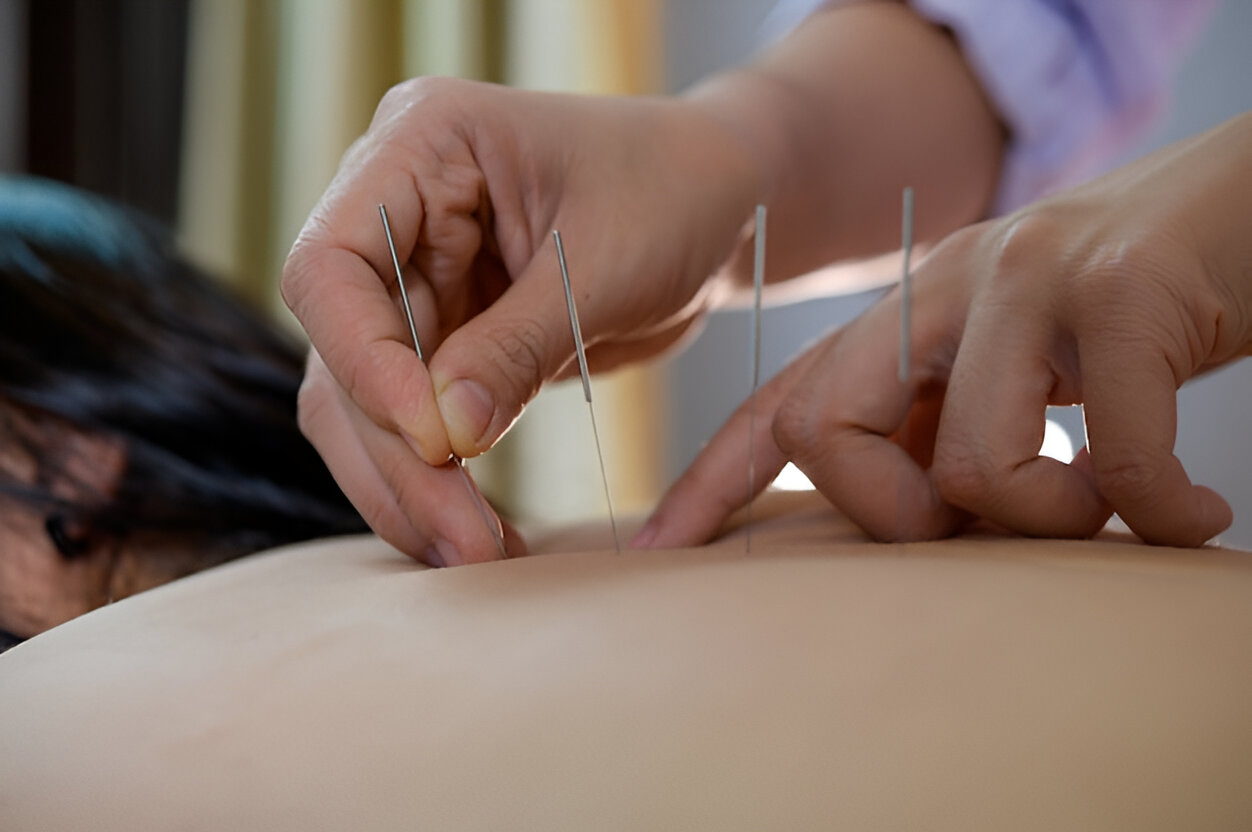 acupuncture session