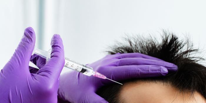 hair transplants