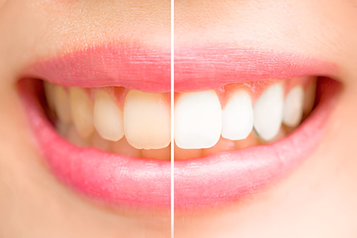 teeth whitening result