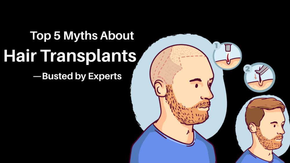 hair transplant myths