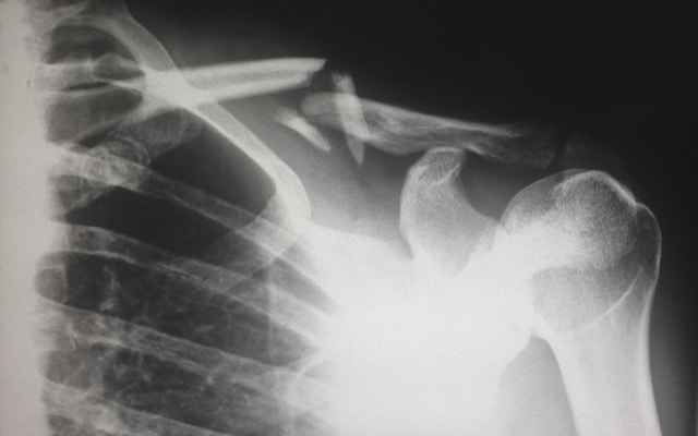 personal injury settlements