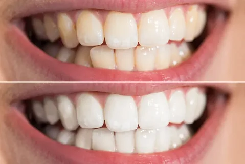 teeth whitening in bastrop