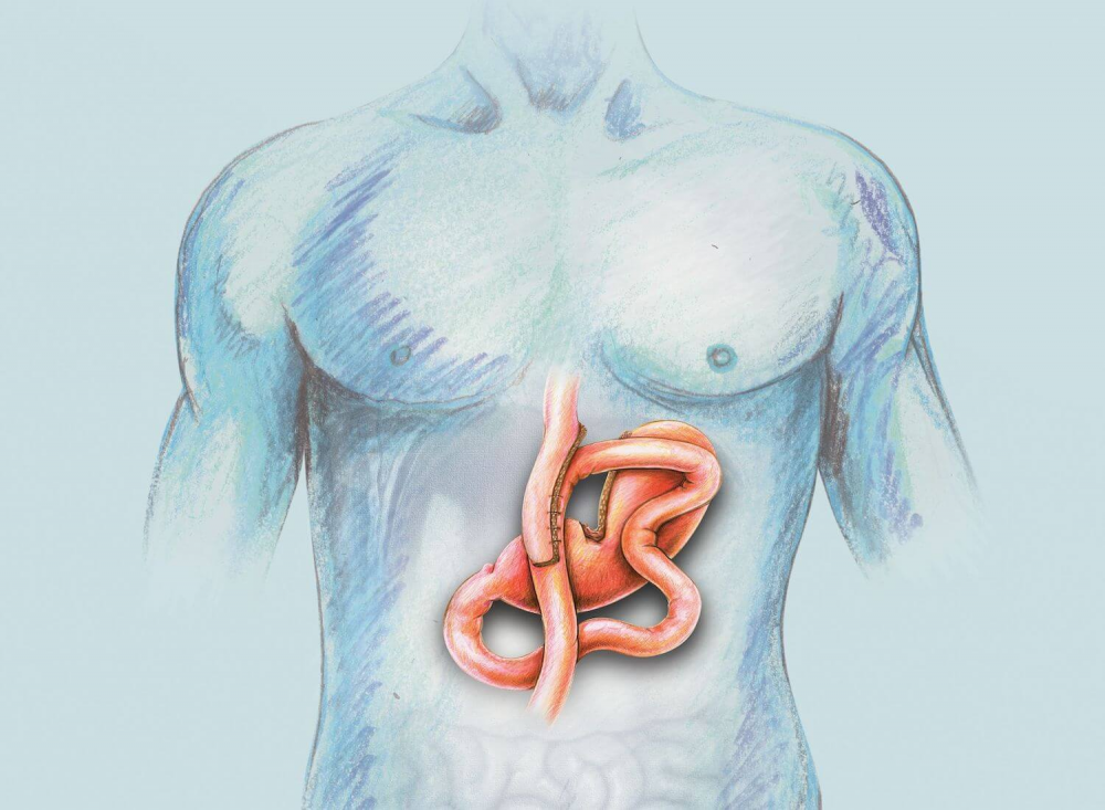 laparoscopic mini gastric bypass