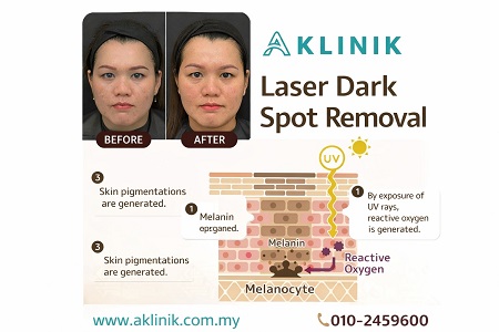 dark spot removal