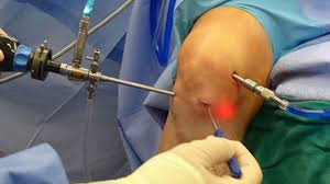 arthroscopic surgery
