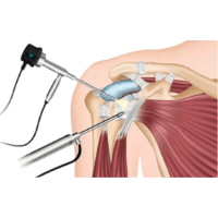 shoulder replacement surgeon in ahmedabad