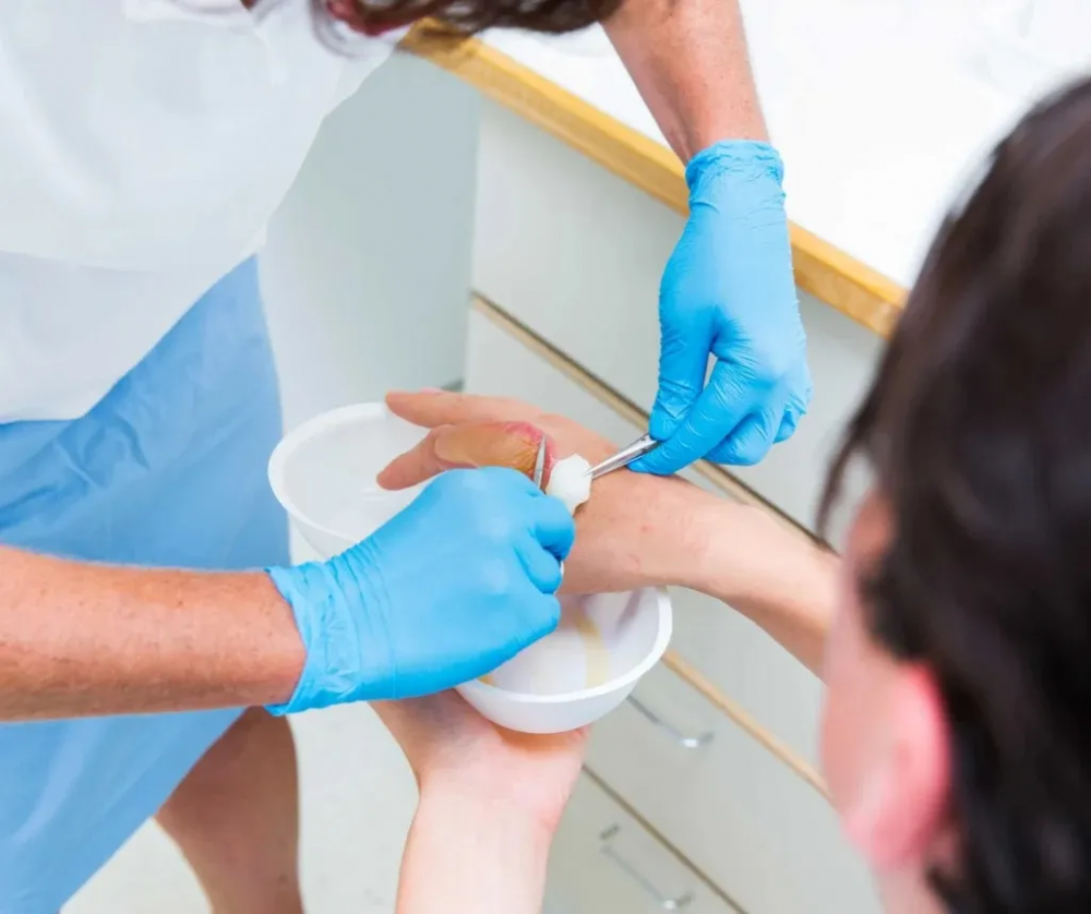 burn treatment tips