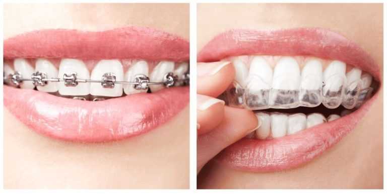 metal braces vs clear aligners
