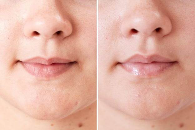 lip flip procedure
