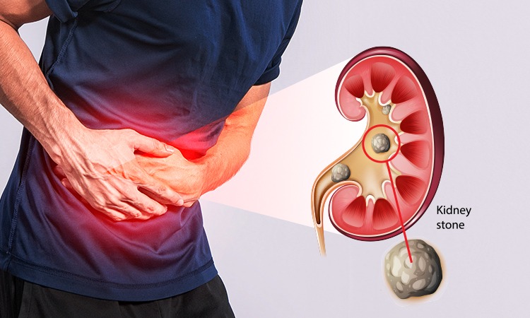 kidney stone symptoms